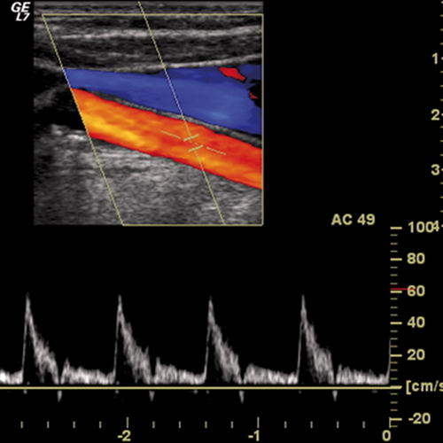 Ecocolor-doppler-per-tronchi-sovraortici-1
